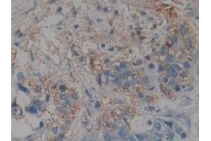 DAB staining on IHC-P; Samples: Human Pancreatic cancer Tissue (NME4 Antikörper  (AA 67-185))