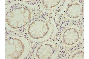 Immunohistochemistry of paraffin-embedded human colon cancer using ABIN7152640 at dilution of 1:100