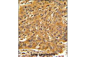 Formalin-fixed and paraffin-embedded human lung carcinoma with Fascin Antibody , which was peroxidase-conjugated to the secondary antibody, followed by DAB staining. (Fascin Antikörper  (AA 322-350))