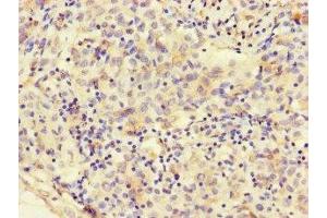 Immunohistochemistry of paraffin-embedded human lung cancer using ABIN7160331 at dilution of 1:100 (FAT Atypical Cadherin 2 (FAT2) (AA 123-314) Antikörper)