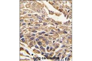 Formalin-fixed and paraffin-embedded human lung carcinoma tissue reacted with ARSB antibody (C-term) (ABIN391670 and ABIN2841581) , which was peroxidase-conjugated to the secondary antibody, followed by DAB staining. (Arylsulfatase B Antikörper  (C-Term))