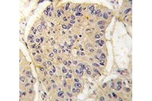 IHC analysis of FFPE human lung carcinoma tissue stained with FKBP12 antibody (FKBP1A Antikörper  (AA 43-74))