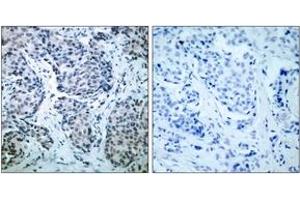 Immunohistochemistry analysis of paraffin-embedded human breast carcinoma, using SEK1/MKK4 (Phospho-Thr261) Antibody. (MAP2K4 Antikörper  (pThr261))