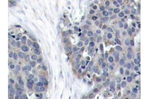 Immunohistochemistry analyzes of Op18 antibody in paraffin-embedded human breast carcinoma tissue. (Stathmin 1 Antikörper)