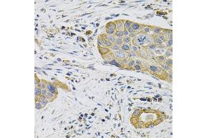 Immunohistochemistry of paraffin-embedded human lung cancer using KRT20 Antibody (ABIN5970078) at dilution of 1/100 (40x lens). (KRT20 Antikörper)