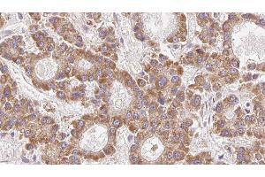 ABIN6279308 at 1/100 staining Human liver cancer tissue by IHC-P. (Claudin 23 Antikörper  (Internal Region))