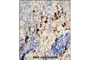 LCE1A antibody immunohistochemistry analysis in formalin fixed and paraffin embedded human skin carcinoma followed by peroxidase conjugation of the secondary antibody and DAB staining. (LCE1A Antikörper  (C-Term))