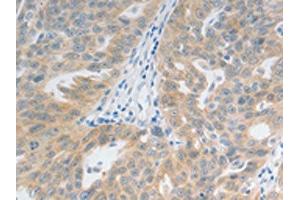 The image on the left is immunohistochemistry of paraffin-embedded Human ovarian cancer tissue using ABIN7192728(TACR2 Antibody) at dilution 1/20, on the right is treated with synthetic peptide. (TACR2 Antikörper)