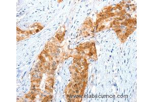 Immunohistochemistry of Human cervical cancer using ANXA8 Polyclonal Antibody at dilution of 1:35 (Annexin VIII Antikörper)