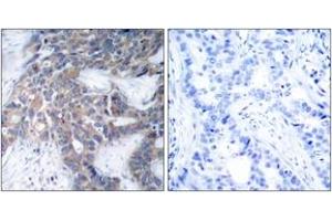 Immunohistochemistry analysis of paraffin-embedded human breast carcinoma, using MEK1/2 (Phospho-Ser217) Antibody. (MEK1/2 Antikörper  (pSer218))