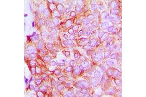 Immunohistochemical analysis of ATP1A1 staining in human breast cancer formalin fixed paraffin embedded tissue section. (ATP1A1 Antikörper  (N-Term))