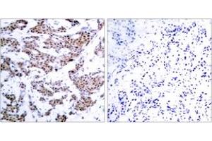 Immunohistochemistry analysis of paraffin-embedded human breast carcinoma, using MEF2A (Phospho-Thr312) Antibody. (MEF2A Antikörper  (pThr312))