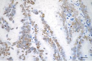 Immunohistochemistry was performed on paraffin-embedded human ovarian carcinoma using checkpoint kinase 2 antibody (ABIN7798039), 1:200).