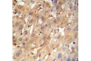 NEU4 antibody immunohistochemistry analysis in formalin fixed and paraffin embedded human hepatocarcinoma. (Sialidase 4 Antikörper  (AA 423-452))