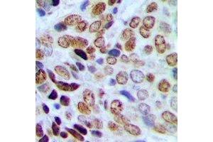 Immunohistochemical analysis of HP1 gamma (pS93) staining in human prostate cancer formalin fixed paraffin embedded tissue section.