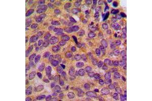 Immunohistochemical analysis of Cytokeratin 5 staining in human breast cancer formalin fixed paraffin embedded tissue section. (Cytokeratin 5 Antikörper  (C-Term))