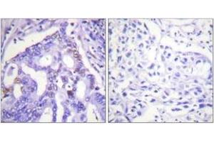 Immunohistochemistry analysis of paraffin-embedded human lung carcinoma tissue, using PIAS4 Antibody. (PIAS4 Antikörper  (AA 451-500))