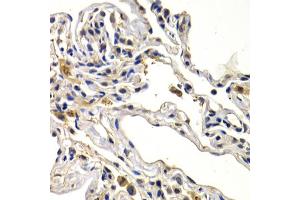 Immunohistochemistry of paraffin-embedded human lung cancer using WNT3A antibody (ABIN6292349) at dilution of 1:200 (40x lens). (WNT3A Antikörper)