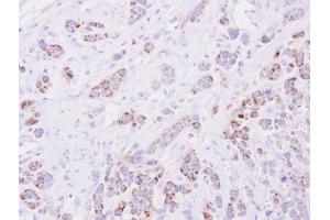 IHC-P Image Immunohistochemical analysis of paraffin-embedded MDA-MB-468 xenograft, using 15-PGDH, antibody at 1:500 dilution. (HPGD Antikörper  (C-Term))