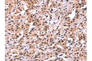 The image on the left is immunohistochemistry of paraffin-embedded Human thyroid cancer tissue using ABIN7191561(MYF5 Antibody) at dilution 1/15, on the right is treated with synthetic peptide. (MYF5 Antikörper)
