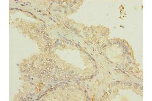Immunohistochemistry of paraffin-embedded human prostate cancer using ABIN7151502 at dilution of 1:100 (ETFDH Antikörper  (AA 34-617))
