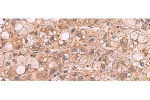 Immunohistochemistry of paraffin-embedded Human liver cancer tissue using PPP2R1A Polyclonal Antibody at dilution of 1:65(x200) (PPP2R1A Antikörper)