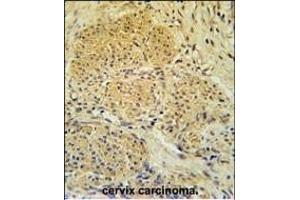 IPO7 Antibody (N-term) (ABIN651626 and ABIN2840333) immunohistochemistry analysis in formalin fixed and paraffin embedded human cervix carcinoma followed by peroxidase conjugation of the secondary antibody and DAB staining. (IPO7 Antikörper  (N-Term))