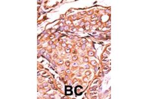 Formalin-fixed and paraffin-embedded human cancer tissue reacted with the primary antibody, which was peroxidase-conjugated to the secondary antibody, followed by AEC staining. (C-JUN Antikörper  (pSer63))
