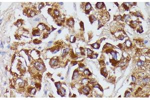 Immunohistochemistry of paraffin-embedded Human liver cancer using AGT Polyclonal Antibody at dilution of 1:100 (40x lens). (AGT Antikörper)