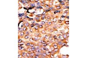Formalin-fixed and paraffin-embedded human cancer tissue reacted with the primary antibody, which was peroxidase-conjugated to the secondary antibody, followed by AEC staining. (PANK3 Antikörper  (Middle Region))