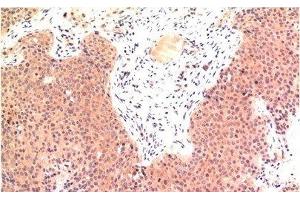 Immunohistochemistry of paraffin-embedded Human colon carcinoma tissue using Epsilon Tubulin Monoclonal Antibody at dilution of 1:200. (TUBE1 Antikörper)