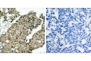 P-Peptide - +Immunohistochemical analysis of paraffin-embedded human breast carcinoma tissue using G3BP-1 (phospho-Ser232) antibody. (G3BP1 Antikörper  (pSer232))