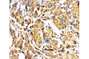 Anti-Bid Picoband antibody,  IHC(P): Human Mammary Cancer Tissue