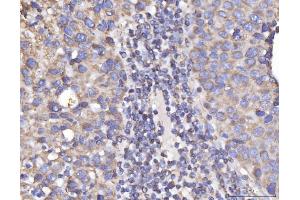 IHC analysis of DLST using anti-DLST antibody (ABIN7599412). (DLST Antikörper  (AA 1-453))