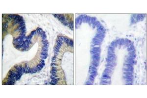 mmunohistochemical analysis of paraffin-embedded human colon carcinoma tissue using 4E-BP1 (Phospho-Ser64) antibody. (eIF4EBP1 Antikörper  (pSer64))