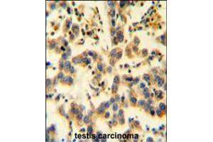 K0090 Antibody immunohistochemistry analysis in formalin fixed and paraffin embedded human testis carcinoma followed by peroxidase conjugation of the secondary antibody and DAB staining. (KIAA0090 Antikörper  (C-Term))