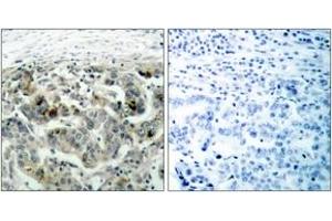 Immunohistochemistry analysis of paraffin-embedded human breast carcinoma tissue, using NF-kappaB p105/p50 (Ab-907) Antibody. (NFKB1 Antikörper  (AA 874-923))
