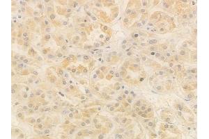 ABIN7095046 and ABIN7099102 at 1/100 staining human renal cell carcinoma by IHC-P.