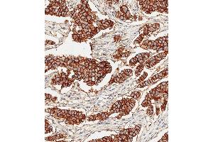 Immunohistochemical analysis of paraffin-embedded Human breast carcinoma tissue using E performed on the Leica® BOND RXm. (ErbB2/Her2 Antikörper)