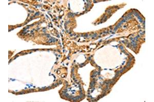 The image on the left is immunohistochemistry of paraffin-embedded Human thyroid cancer tissue using ABIN7131239(STX18 Antibody) at dilution 1/25, on the right is treated with fusion protein. (Syntaxin 18 Antikörper)