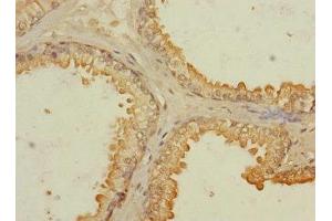 Immunohistochemistry of paraffin-embedded human prostate cancer using ABIN7167139 at dilution of 1:100 (RASSF6 Antikörper  (AA 1-303))