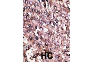 Formalin-fixed and paraffin-embedded human cancer tissue reacted with the primary antibody, which was peroxidase-conjugated to the secondary antibody, followed by AEC staining. (MAGEC1 Antikörper  (C-Term))