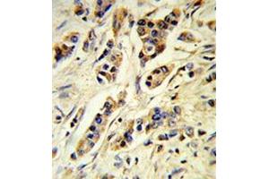Human breast carcinoma (formalin-fixed, paraffin-embedded) reacted with IL10 Antibody , which was peroxidase-conjugated to the secondary antibody, followed by DAB staining. (IL-10 Antikörper  (Middle Region))