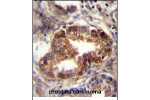 RAB3D Antibody (C-term) (ABIN657140 and ABIN2846278) immunohistochemistry analysis in formalin fixed and paraffin embedded human prostate carcinoma followed by peroxidase conjugation of the secondary antibody and DAB staining. (RAB3D Antikörper  (C-Term))
