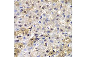 Immunohistochemistry of paraffin-embedded human liver cancer using MAD1L1 antibody. (MAD1L1 Antikörper)