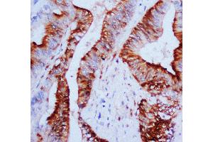 Anti-MAPK1/3 antibody, IHC(P) IHC(P): Human Mammary Cancer Tissue