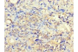 Immunohistochemistry of paraffin-embedded human gastric cancer using ABIN7175332 at dilution of 1:100