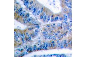 Immunohistochemical analysis of BCLX (pS62) staining in human colon cancer formalin fixed paraffin embedded tissue section. (BCL2L1 Antikörper  (pSer62))