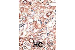 Formalin-fixed and paraffin-embedded human hepatocellular carcinoma tissue reacted with GJB2 polyclonal antibody  , which was peroxidase-conjugated to the secondary antibody, followed by DAB staining. (GJB2 Antikörper  (C-Term))