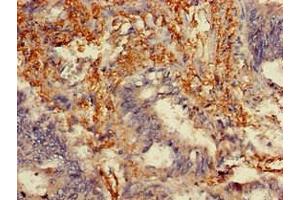 Immunohistochemistry of paraffin-embedded human colon cancer using ABIN7159304 at dilution of 1:100 (Melanophilin Antikörper  (AA 310-539))
